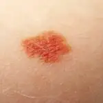 Hemangioom; ervaringen met een rode aardbeienvlek bij een baby - Mamaliefde.nl
