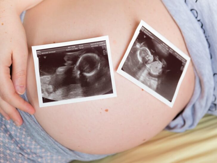 Vermoeden zwanger van een tweeling; symptomen zwangerschap herkennen