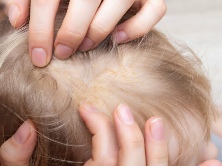 Berg baby; wat is het en tips wat te doen om schilfertjes op de hoofd huid verwijderen - Mamaliefde.nl