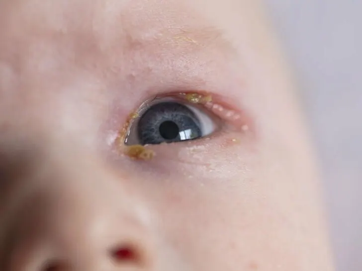 Ontstoken oog baby; gevaarlijk, besmettelijk hoe behandelen of schoonmaken?- Mamaliefde.nl