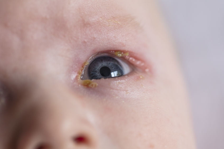 Ontstoken oog baby & kind; gevaarlijk, besmettelijk prut & etter behandelen
