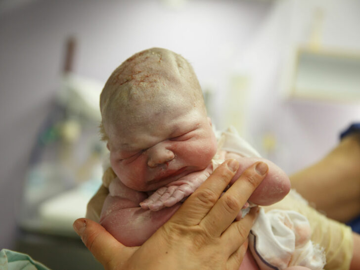 Tangverlossing en vacuümpomp bevalling; gevolgen baby na geboorte