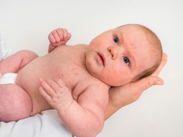 Baby acne - Mamaliefde.nl