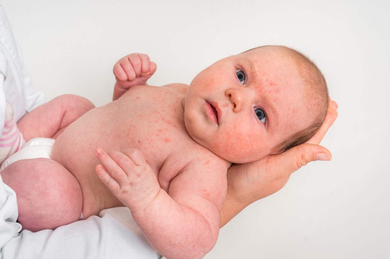 Baby acné; tips tegen puistjes en pukkeltjes bij kinderen