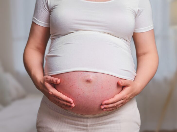 Acne tijdens zwangerschap